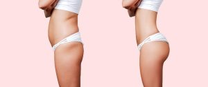 mommy makeover and hysterectomy