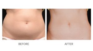 how to get a mommy makeover without surgery