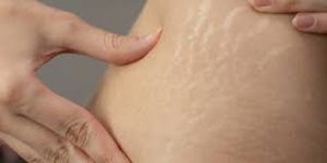 stretch marks