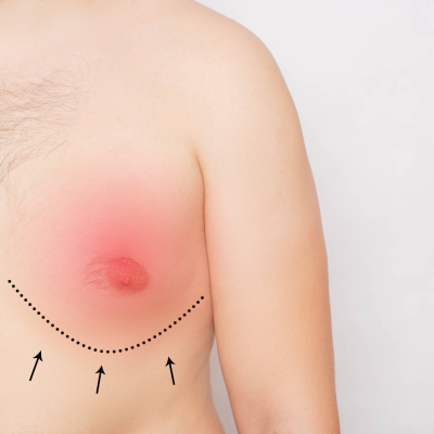 breast pain
