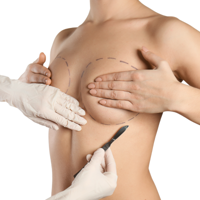 breast revision